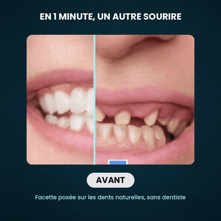 Facette dentaire — miniature 3
