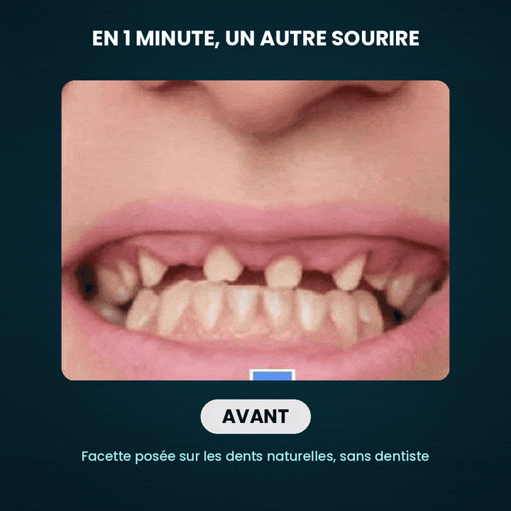 Facette dentaire — miniature 6
